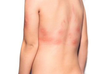 Fototapeta na wymiar prickly heat on skin back children