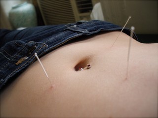 Female patient undergoing acupuncture treatment with needles 