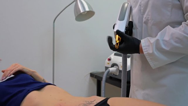 Video of laser tattoo removing from the belly