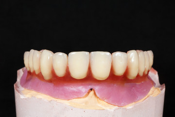 ceramic prosthesis with an artificial maxillary gingiva