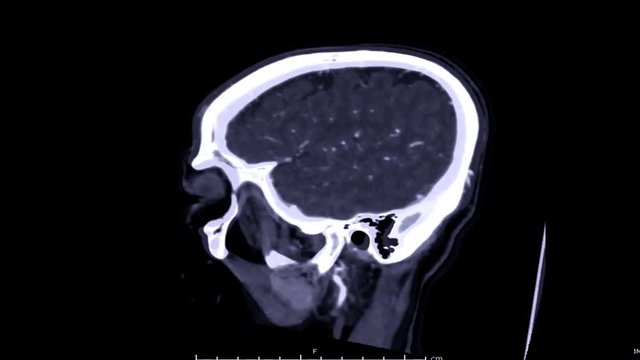  CTA  brain 3D Rendering image in sagittal plane showing vessel of the brain.