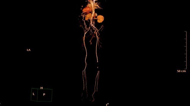 CT Scan  3D rendering image of CTA femoral artery run off showing vessels in human body.