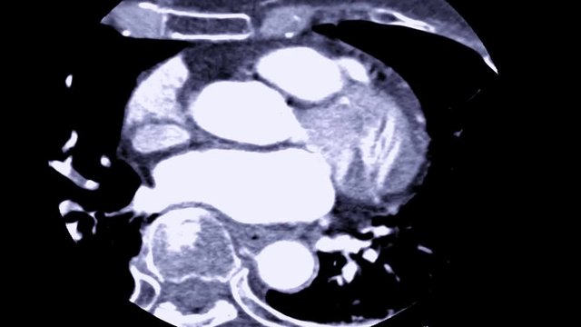 CT Angiography or or CTA of Coronary artery  in Axial view with MIP technique  with injection contrast media agent