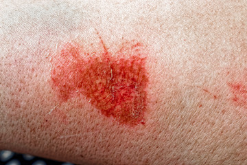 Scratched skin on arm, toned