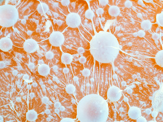 cancer tumour.