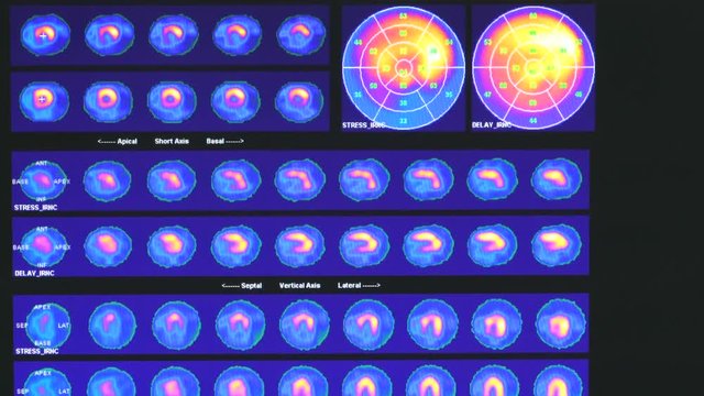 MRT of the heart and coronary vessels using contrast fluid and stress