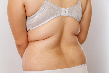 A 24 year old girl after 2 years of hormonal treatment on a white background shows changes in the...