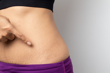 Women Show off the belly after birth. Stretch Marks on white background