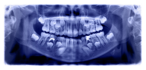Panoramic radiograph is a scanning dental X-ray of the upper jaw maxilla and lower jawbone mandible a child aged 7 seven years.