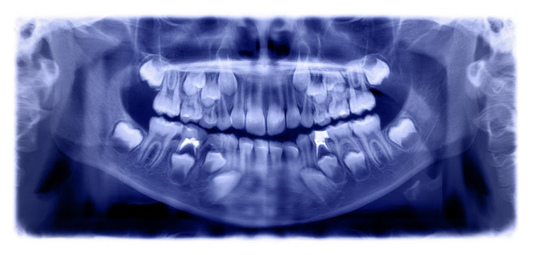 Panoramic radiograph is a scanning dental X-ray of the upper jaw maxilla and lower jawbone mandible a child aged 7 seven years.