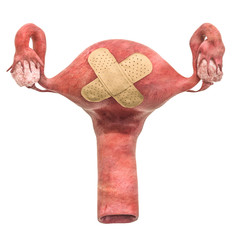 Female uterus with adhesive bandages. Treatment of uterus concept, 3D rendering