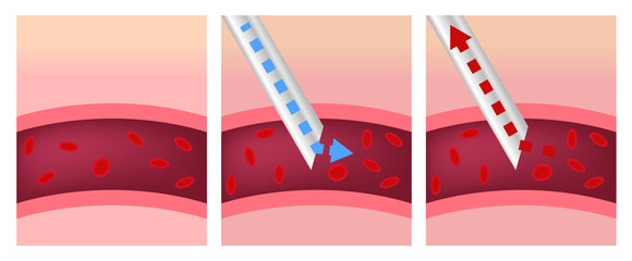 syringe sucking a blood out of blood vessel