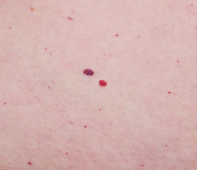 Hemangioma, microhematoma on human skin, close-up, disease