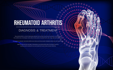 Rheumatoid arthritis Bones the of foot - obrazy, fototapety, plakaty