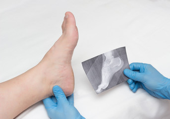 A doctor in medical gloves holds an x-ray of the foot and examines a sore leg with a heel spur on a woman, close-up, osteophytes and heel, fascia