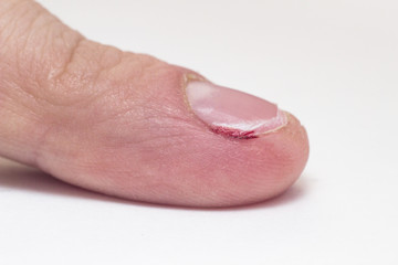 Finger with severed nail and burr, blood, macro, white background, cuticle, copy space, barb