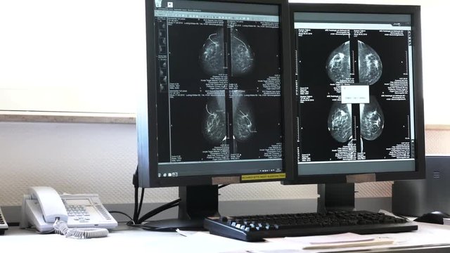 Medical monitor with the results of patient famale breast cancer research