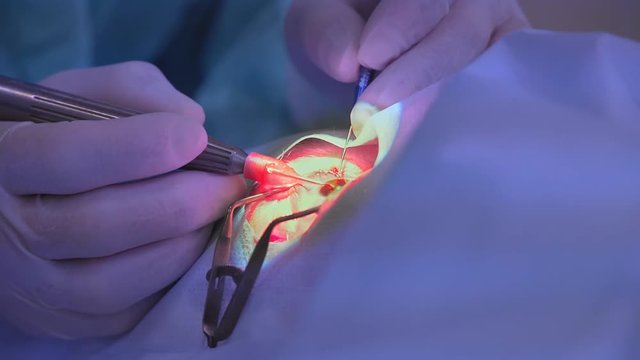 Eye surgery. The doctor works with the lens. Ophthalmic surgery
