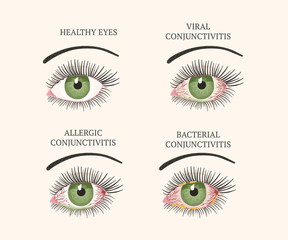 Eye disease. Ophthalmology health illustration.