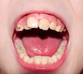 baby mouth, crooked teeth caries 