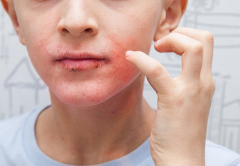 Boy scratching his face. Human skin, presenting an allergic reaction, allergic rash on face and lips. - obrazy, fototapety, plakaty