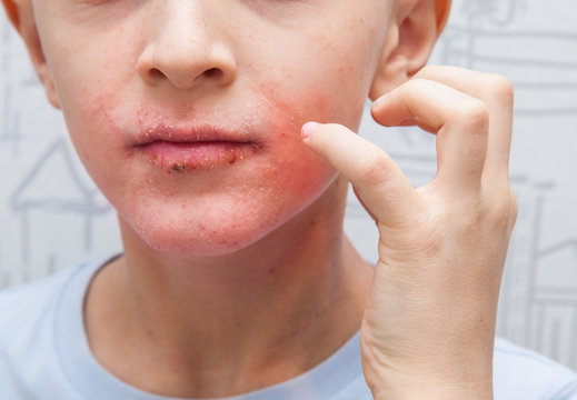 Boy scratching his face. Human skin, presenting an allergic reaction, allergic rash on face and lips.