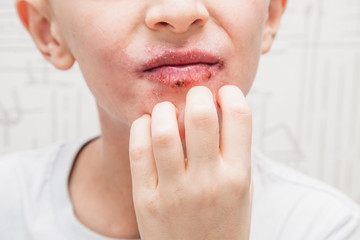 Boy scratching his face. Human skin, presenting an allergic reaction, allergic rash on face and...