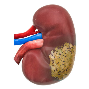 Kidney disease concept, 3D rendering