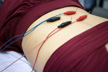 Dry needling EPI needle