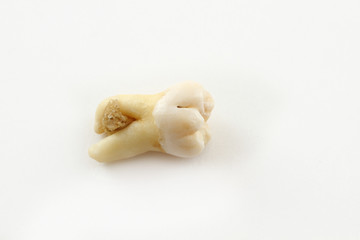 Fototapeta na wymiar Eighth lower tooth removed together with a piece of bone tissue on paper. Wisdom tooth