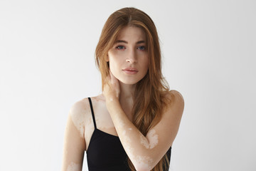 Fototapeta premium Vitiligo affected young woman with blue eyes and loose hairdo posing isolated in studio, holding hand onher neck and staring at camera. Female with bad tan problem. Dermatology and skin disorder