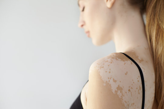 People, dermatology, cosmetology and skin condition concept. Side view of attractive young Caucasian female wearing black bra showing white vitiligo spots. Selective focus on woman's shoulder