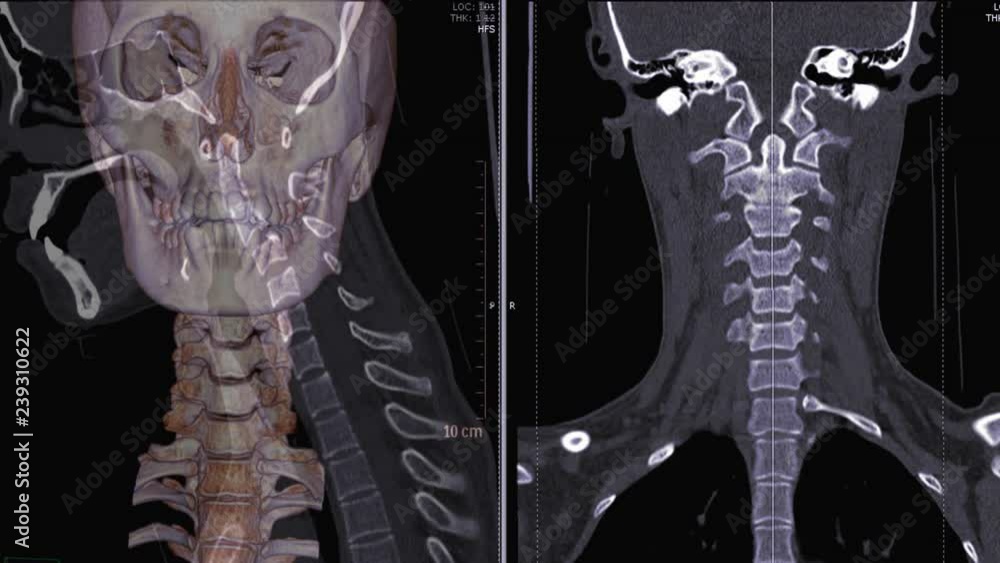 Poster ct scan of cervical spine ( c-spine ) 3d rendering image comparison sagittal plane and coronal plane