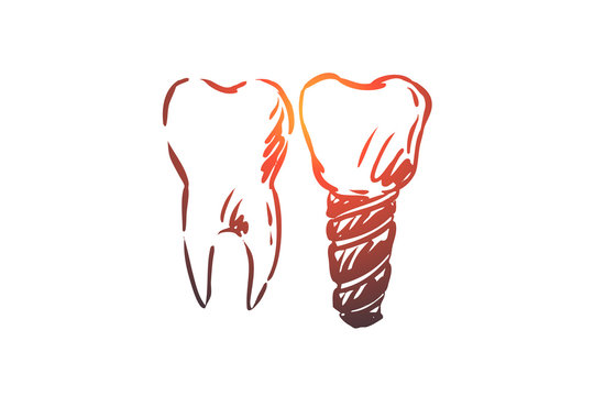 Implant, dental, tooth, health, care concept. Hand drawn isolated vector.