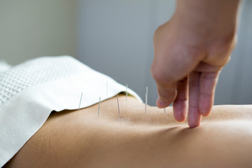 traditional acupuncture treatment - obrazy, fototapety, plakaty