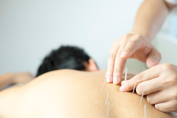traditional acupuncture treatment - obrazy, fototapety, plakaty