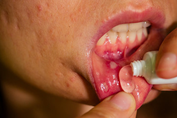 close - up on the lip with aphthous stomatitis applying antibacterial cream - obrazy, fototapety, plakaty