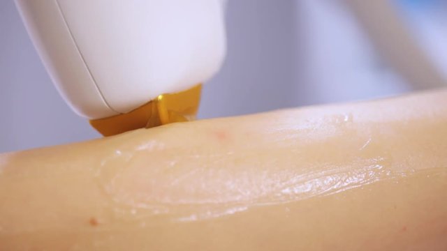 Macro close-up procedure of laser hair removal on a diode laser. Removing hairs on skin