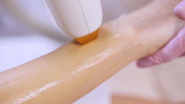 Close-up procedure of removing hairs on hand. Laser hair removal on a diode laser, tracking moving camera