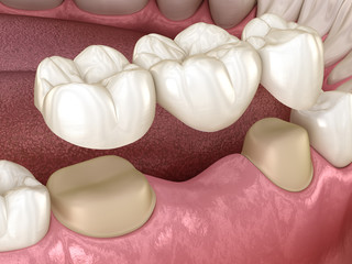 Dental bridge of 3 teeth over molar and premolar. Medically accurate 3D illustration of human teeth treatment