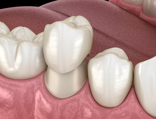 Dental crown premolar tooth assembly process. Medically accurate 3D illustration of human teeth...