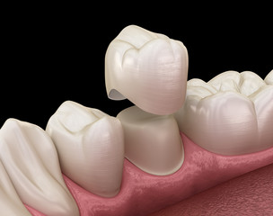 Dental crown premolar tooth assembly process. Medically accurate 3D illustration of human teeth treatment - 239374670