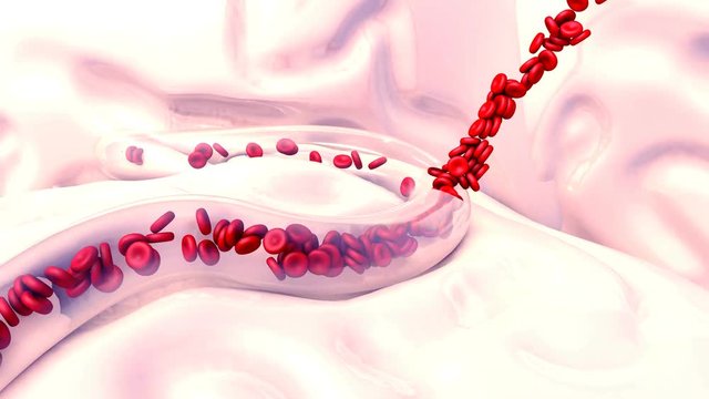 Brain Hemorrhage or Hemorrhage 