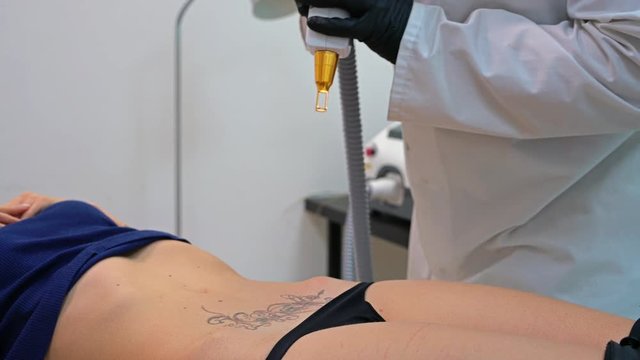 Process of laser tattoo removing from the belly