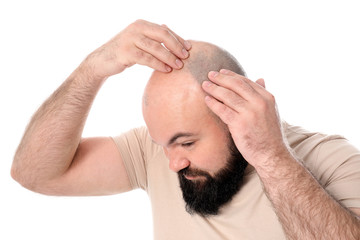 Man with hair loss problem on white background