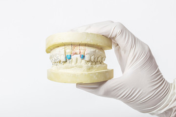 Plaster cast of teeth in the hand