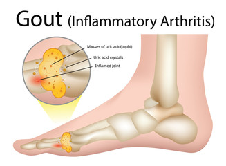Obraz premium Gout (Inflammatory arthritis) Gout is an intensely painful type of arthritis , Illustration - Vector
