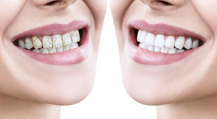 Fototapeta premium Teeth of young woman before and after treatment.