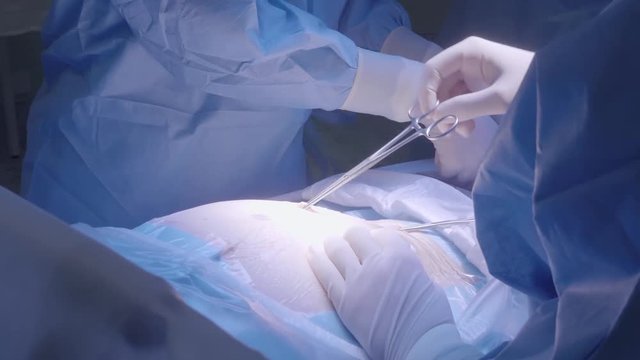 Medical Team Performing Surgical Operation in Bright Modern Operating Room.