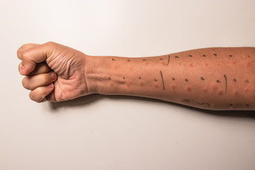 Allergy test in an arm